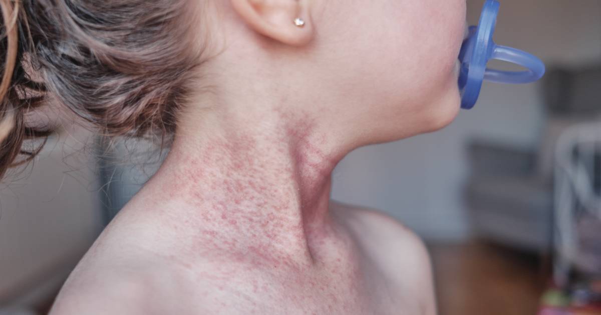 Muito além da pele: a realidade de quem vive com dermatite atópica no SUS