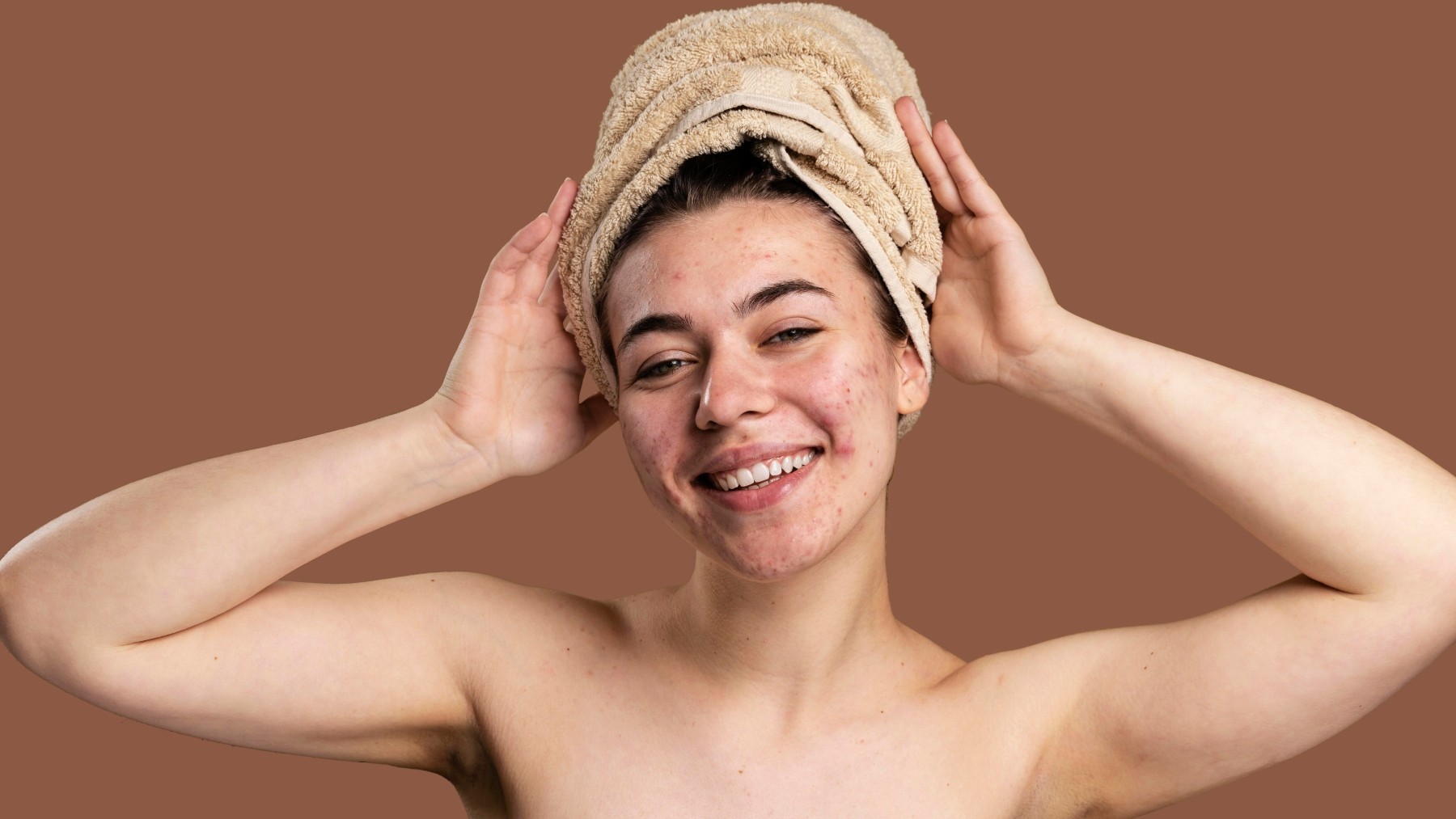 Espinhas na vida adulta: por que elas insistem em aparecer?